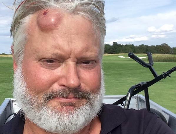 La pallina da golf lo colpisce in piena fronte, il selfie su Facebook
