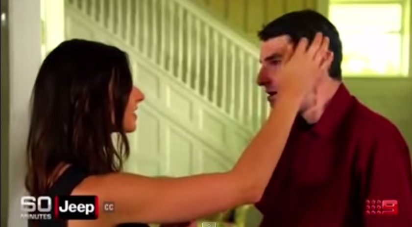 Donna incontra l’uomo a cui è stato trapiantato il viso del fratello morto