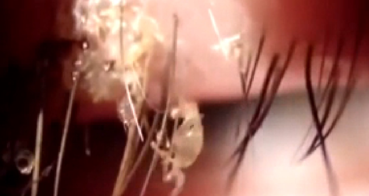 “Mamma, qualcosa si muove nel tuo occhio”, la scoperta choc