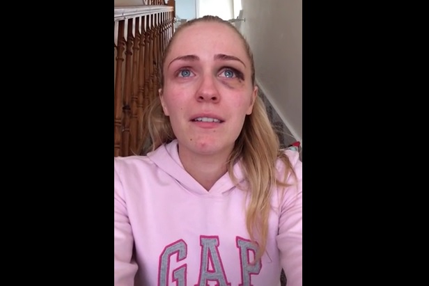 Mostra i segni del pugno ricevuto dall’ex compagno – Il video choc