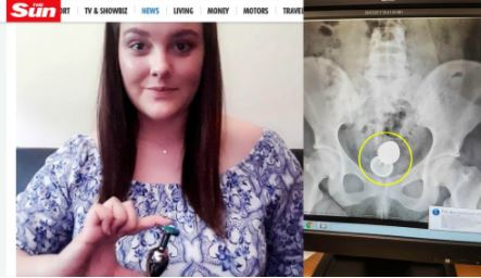 Sex toy incastrato nel corpo, 20enne finisce sotto i ferri