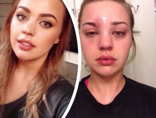 Schiaccia un brufolo e rischia di morire, l’incredibile storia di Katie