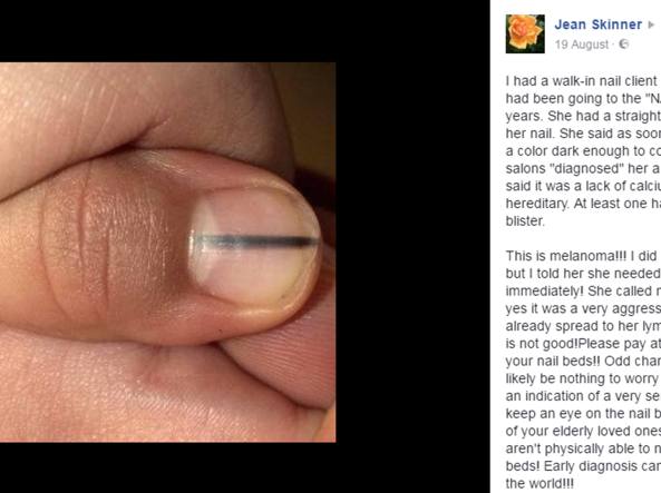 “Fai vedere al medico quella riga nera”, l’estetista salva la vita alla cliente