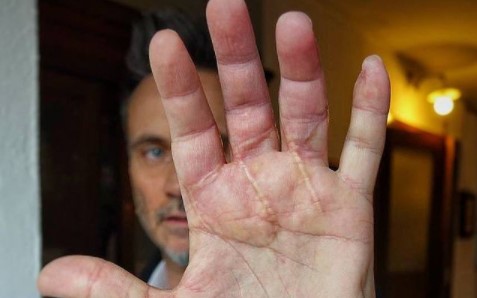 Nek mostra le cicatrici dell’incidente: “Ecco la mia mano oggi”