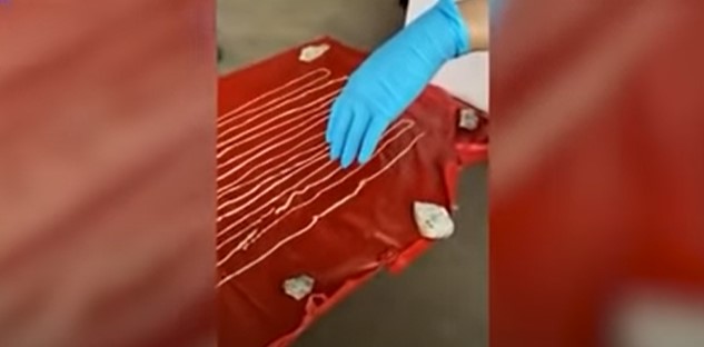 Corre in ospedale per una forte flatulenza: aveva un verme di 18 metri nello stomaco