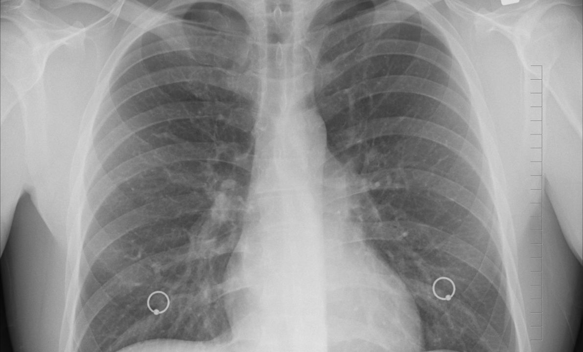 Curata per mesi per una tubercolosi, scopre di avere un preservativo nei polmoni