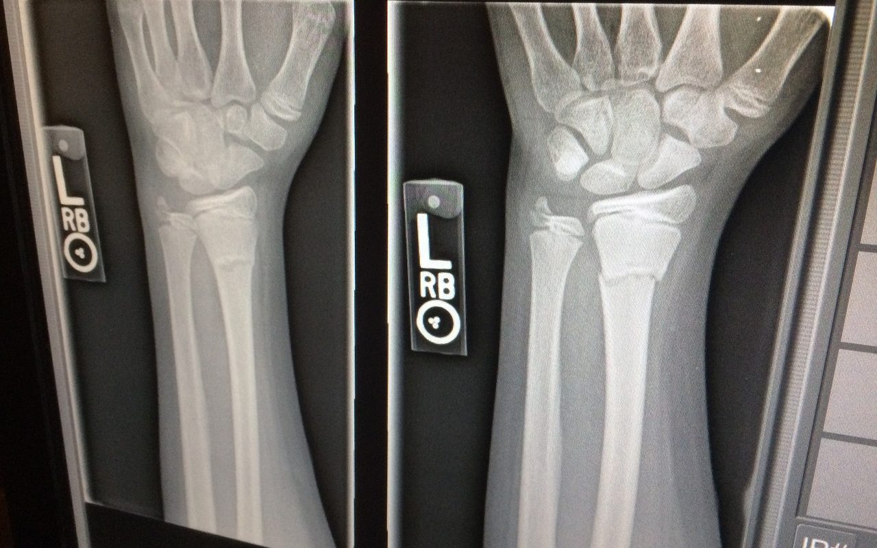 Si rompe il braccio due volte nello stesso giorno