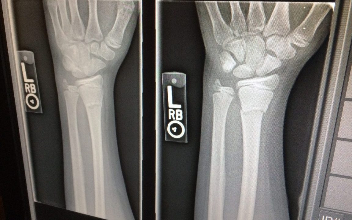 Si rompe il braccio due volte nello stesso giorno