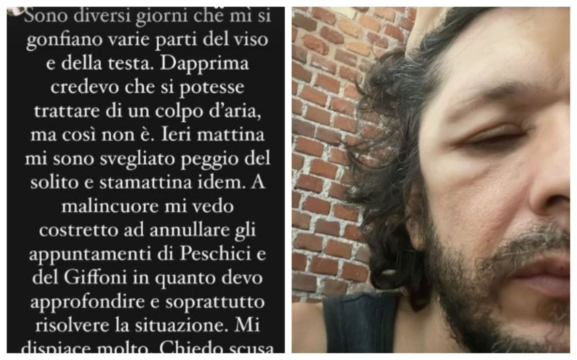 Ermal Meta choc: “Mi si gonfiano parti del viso e della testa”
