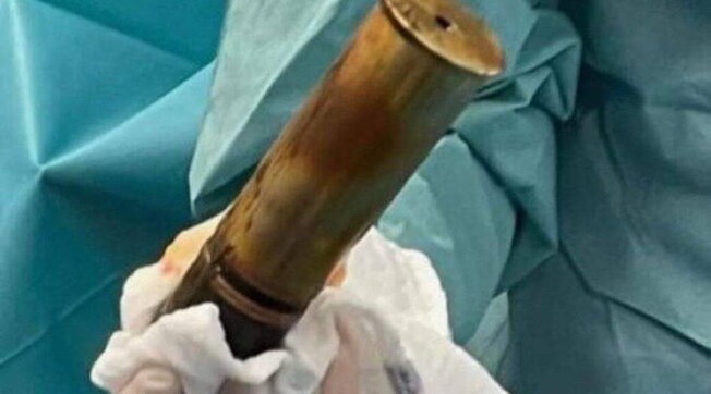 Si presenta in ospedale con una bomba nel retto, scatta l’evacuazione