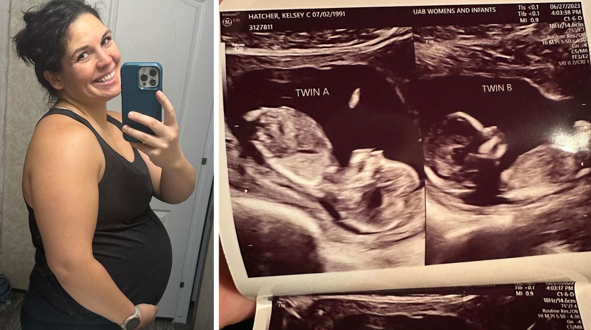 Donna con due uteri resta incinta in entrambi contemporaneamente