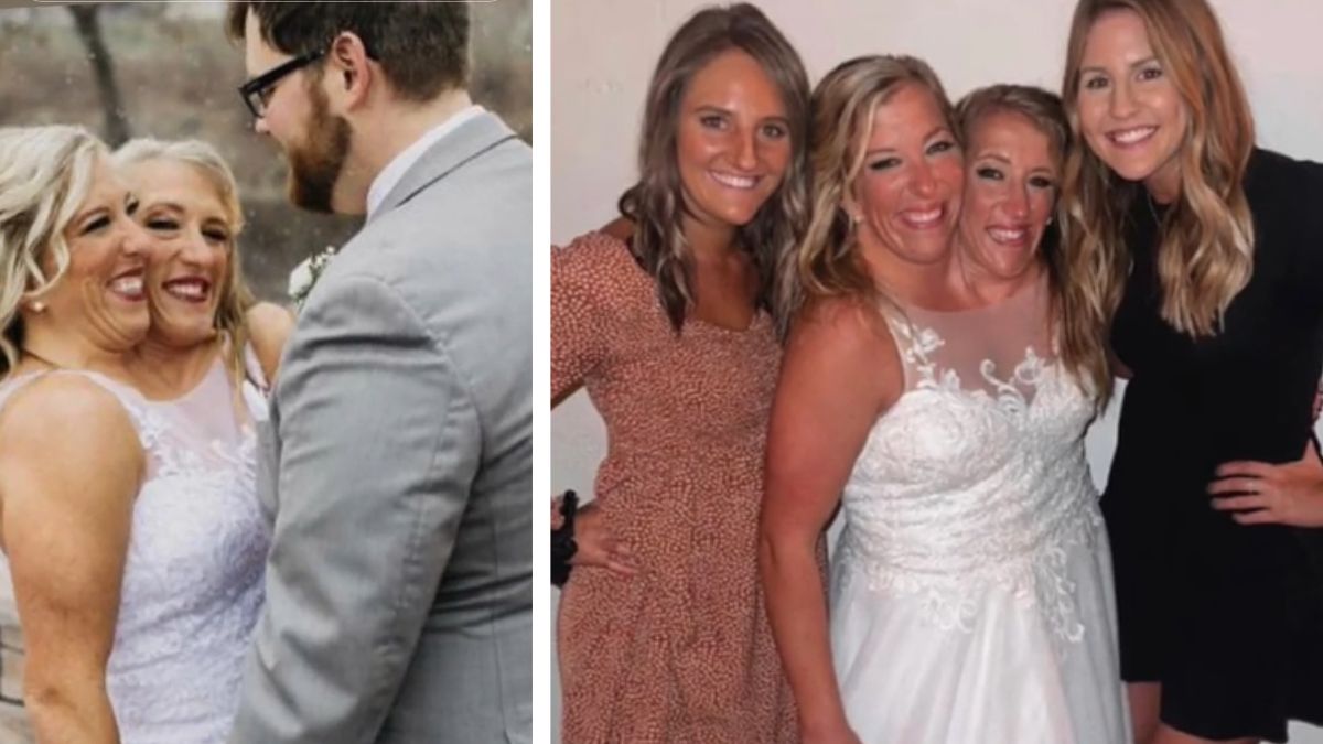 Gemelle siamesi, Abby Hensel si è sposata